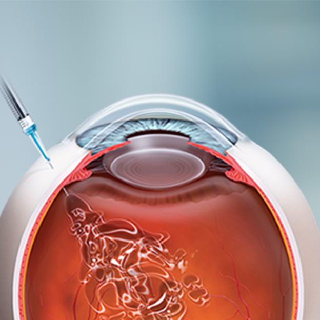 Интравитреальные инъекции ИВВИА