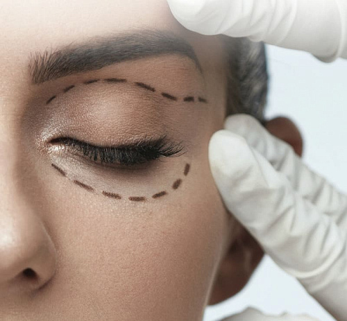 Памятка пациенту - блефаропластика